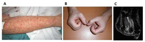 치쿤군야 바이러스 감염의 임상적 증상. (A) 급성감염시 나타나는 피부발진, (B-C) 만성 감염시 나타나는 관절이 붓고 꺾이는 증상과 골관절의 염증증상.