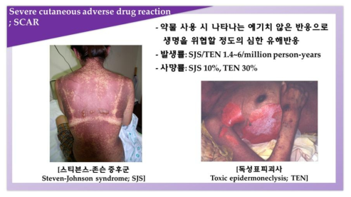 중증피부약물이상반응