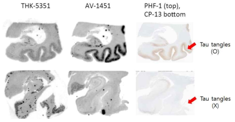 (위) Tau tangle이 존재하는 AD 환자의 사후 hippocampus 뇌조직의 autoradiography. [18F]AV1451의 경우 강하게 발색이 된 반면, [18F]THK5351의 경 우 상대적으로 흐림. (아래) Tau tangle이 존재하지 않는 hippocampus 뇌조직의 autoradiography. [18F]AV1451의 경우 발색 부분이 적은 반면 [18F]THK5351은 여러 부분에서 강한 발색이 보임.