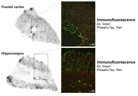 AD 환자 뇌조직의 immunofluorescence 이미지