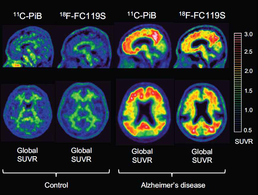 11C-PiB PET과 18F-FC119S PET 영상
