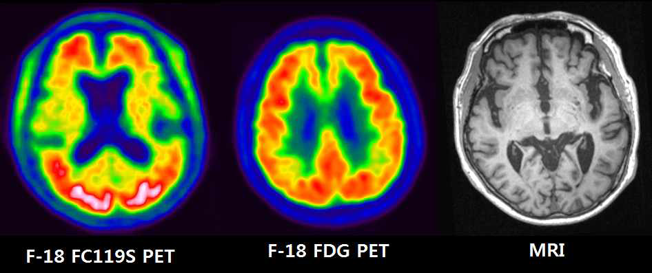 알츠하이머치매 환자의 18F-FC119S PET, 18F-FDG PET 및 MRI