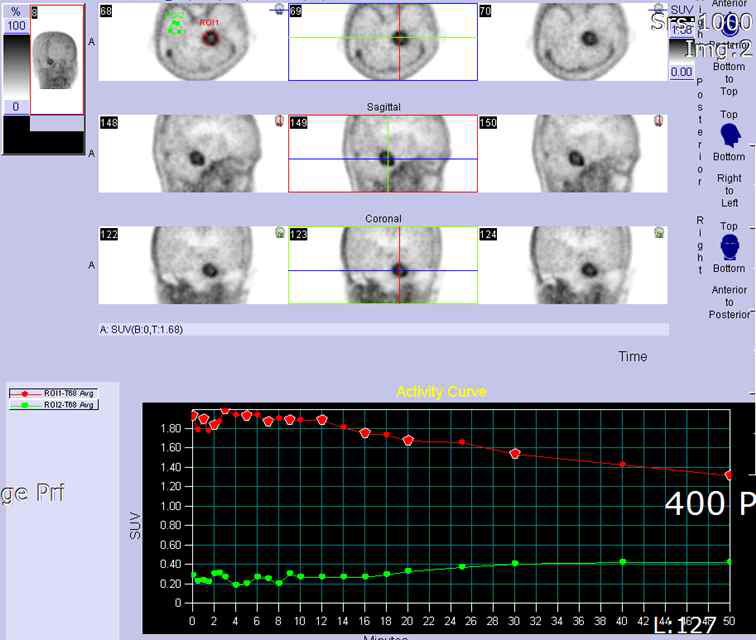 뇌종양의 18F-FMT PET 시간-방사능 곡선