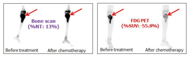 항암치료반응이 나빴던 환자에서 뼈스캔과 PET의 변화