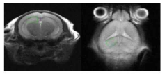 T1WI MRI 영상 확인 후, hippocampus 에 voxel (1.2*1.5*2.0 mm)을 위치시키고 MRS 스펙트럼 획득함