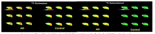 대조군 (WT)과 실험군 (AD) 뇌에서의 PET 영상 비교