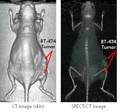 I-125 SPECT/CT 3D 영상