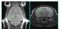 T1WI MRI (좌), hippocampus 에 voxel (1.2*1.5*2.0 mm)을 위치시키고 MRS 스펙 트럼 획득 (우)