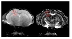 Diffusion Tensor MRI (좌), 분할비등방도 (fractional anisotropy; FA) (우)에서 관심 영역 설정