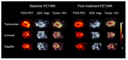 보조항암화학요법 전・후 FDG-PET, ADC map 영상화 및 정의된 종양 영역