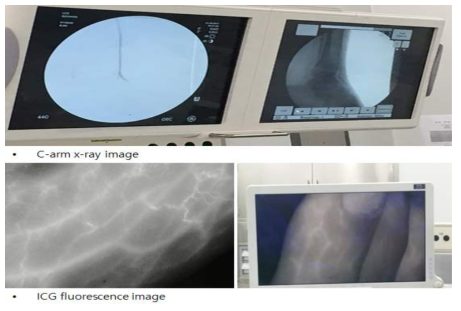 임상시험에서 C-arm x-ray(상) 와 형광영상(하) 의 비교