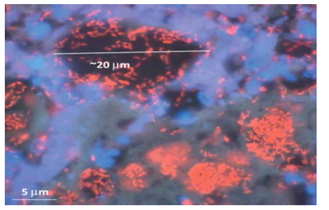 만성 피부감염조직에서 형성된 biofilm. 염 미생물(적색), biofilm 주변 면역세포(청색)