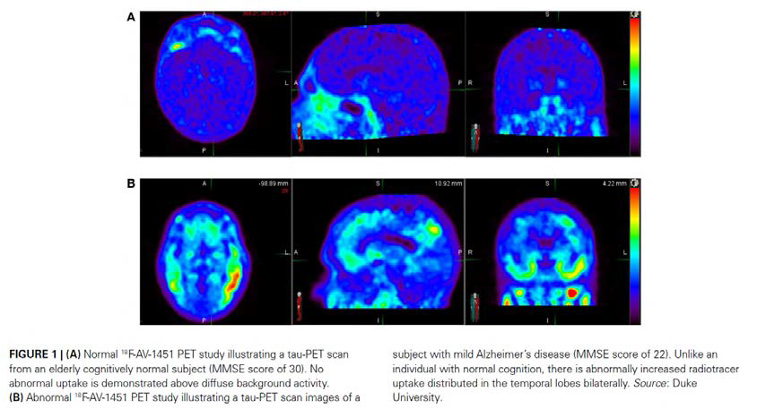 알츠하이머 치매를 유발하는 타우 단백질을 판독하는 18F-방사성의약품의 PET 영상 (Frontiers in Neurology, Vol. 6, 2 (2015)