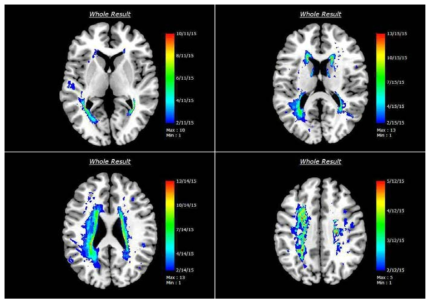 Frequency map. WMH가 주로 관찰되는 부위는 뇌실 주변으로서 Moyamoya-like cerebral vessel을 가지지 않는 환자에서 관찰되는 WMH 분포와 유의한 차이를 보이지 않았음