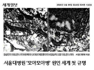 모야모야병 혈관내 피전구세포에서 mitochondrial 이상에 대한 신문기사