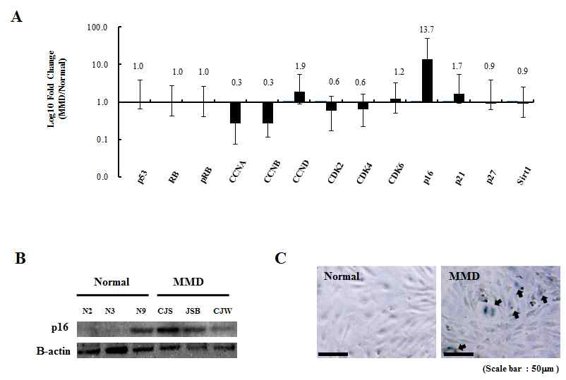 모야모야병 혈관내피전구세포에서 p16protein 발현이 높으며 senescence가 관찰됨