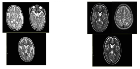 Thiamine 대사와 관련된 유전자 SLC19A3 변이가 발견된 환자들의 뇌자기공명영상 사진들