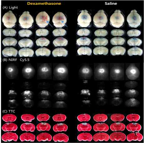 뇌정맥 동-혈전증 유발 24시간째에 dexamethasone or saline 주입하고 30 분 뒤 희생시켜 얻은 전뇌와 절편의 Light, NIRF -cy5. 5형광, TTC staining 전, 후의light 사진