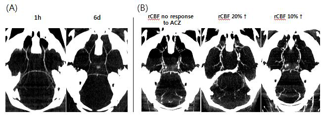 Microfil® 를 이용한 ACZ 반응에 따른 P1 artery patency 확인