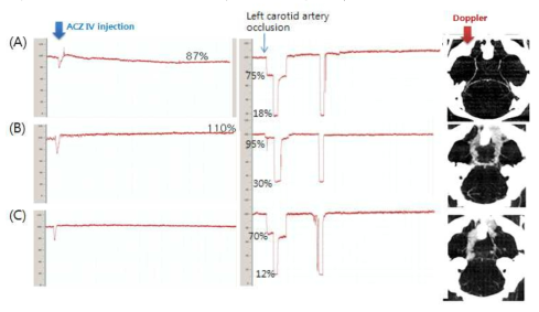 ACZ 반응에 two-stage BCAO 후 혈류량 변화와 Microfil 주입 혈관 영상화