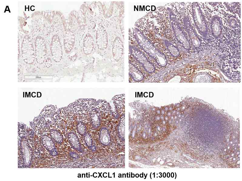 Immunohistochemistry for CXCL1. Immunohistochemical staining against the CXCL1 revealed no expression in normal mucosa and sequential up-regulation in non-inflamed and inflamed CD mucosa