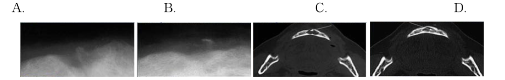 사진 수술전(A) 수술 후 4개월(B), computed tomography 수술전(C) 수술 후 6개월(D)