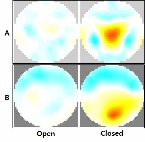 상기도 상, 하부의 도전율 단층 영상 비교 실시 예. A. 연구개 뒤 공간 높이, B.설근부 뒤 공간 높이. Open, 정상 호흡시; Closed,연하 운동에 의한 기도 폐쇄 유발시
