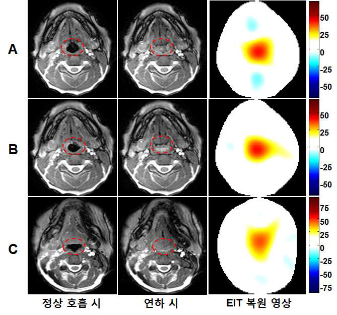 상기도 EIT 영상의 해부학적 검증. A-C: individuals with different airway shapes. EIT 영상은 연하 시와 정상 호흡시의 도전율 변화값을 영상화한 것으로 MRI에서 정상 호흡시 보이는 상기도의 모양과 유사한 것을 확인함