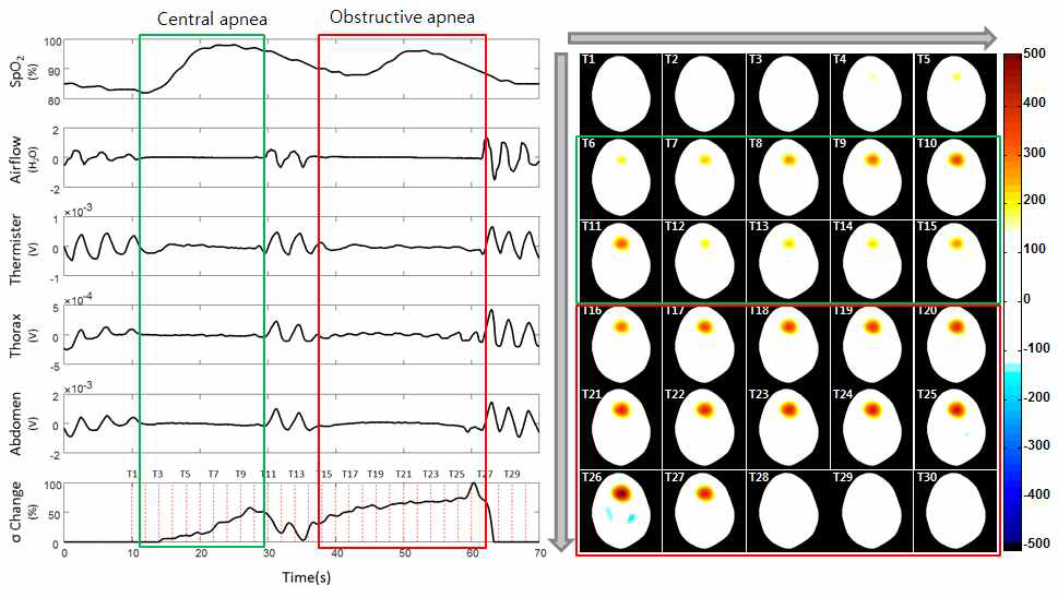 중추성 무호흡과 폐쇄성 무호흡의 PSG 및 EIT 동시 측정 결과 비교. (좌) PSG 데이터 와 EIT conductivity 변화값의 동기화 데이터, (우) 폐쇄성 무호흡 발생 시 EIT 영상의 변화. 초록색 블록: 중추성 무호흡 구간, 빨간색 블록: 폐쇄성 무호흡 구간