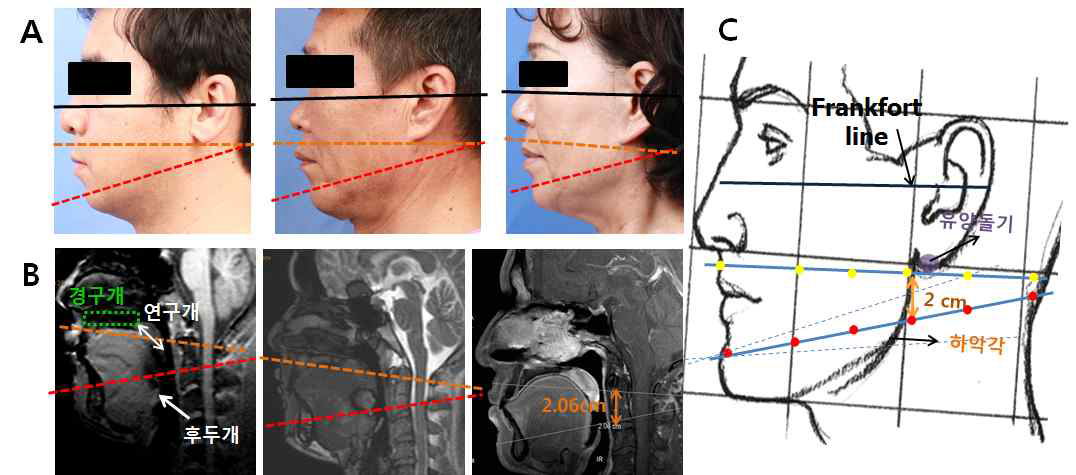 표면전극 부착 위한 해부학적 지표 개발. A. 성인 남녀의 의학사진 측면 분석, B. 성인 남녀 두경부 MRI의 정중 시상면 분석, C. 연구개 뒤 및 설기저부 측정을 위한 표 면전극 부착 부위 모식도