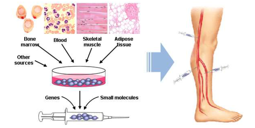 줄기세포를 이용한 하지허혈의 세포치료기술