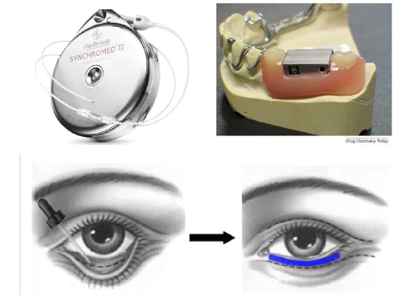 Implantable device (상좌; 약물소진 혹은 장치 문제 발생 시 제거목적의 개복 수술이 필요, 국소의치를 이용한 약물전달 장치 (기본적으로 착탈식이며, 점막을 통한 약물 전달 방식임), 안과에서 많이 시술되는 conjunctival implant (흡수성 소재로서 1회 시술로 상당 기간의 약물 방출을 목표로 하고 있으나 매 회 재시술이 필요함