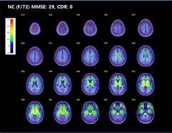 정상군의 18F-THK5351 PET 의 SUVR map