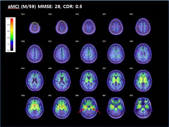 기억형경도인지장애 환자의 18F-THK5351 PET 의 SUVR map