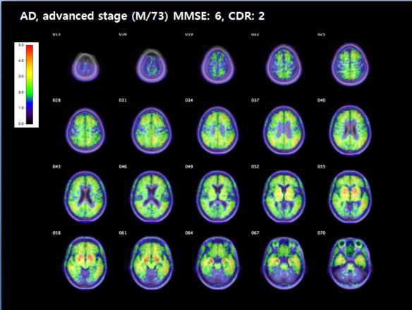 알츠하이머 치매 환자의 18F-THK5351 PET 의 SUVR map