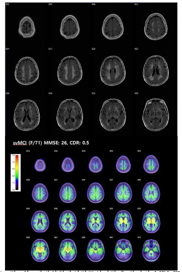 위: 피질하혈관성경도인지장애 환자의 MRI FLAIR 영상, 아래: 동일 환자의 18F-THK5351 PET 영상