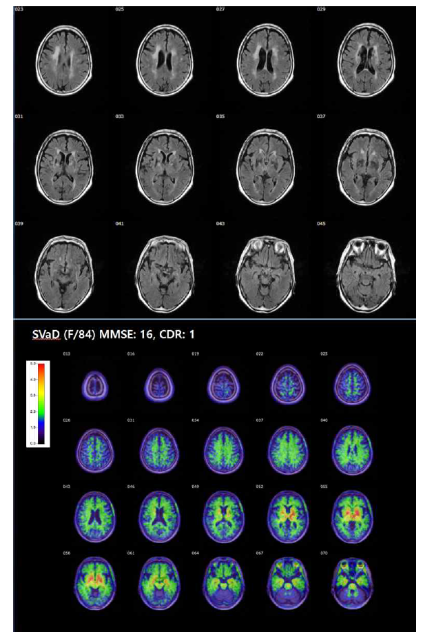 위: 피질하혈관성치매 환자의 MRI FLAIR 영상, 아래: 동일 환자의 18F-THK5351 PET 영상