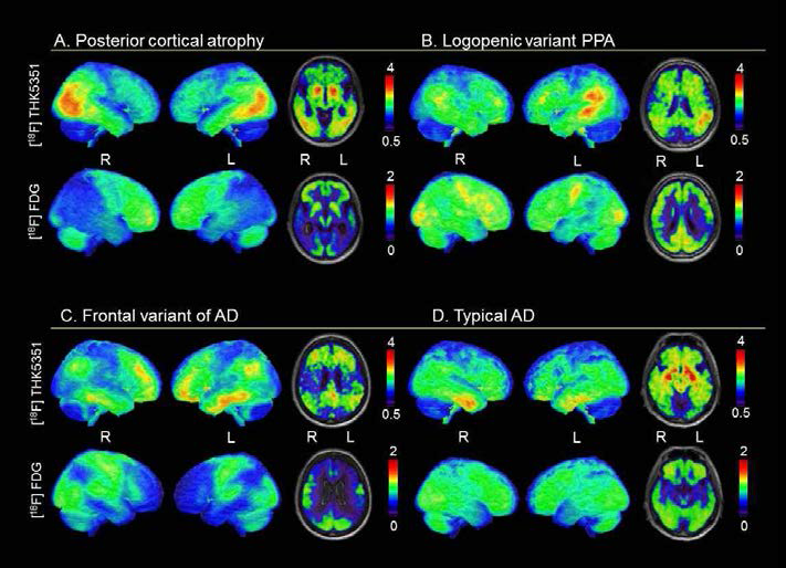 변이형 알츠하이머병에서도 THK5351 PET 은 임상증상 및 포도당 대사 저하와 연관되어 있음