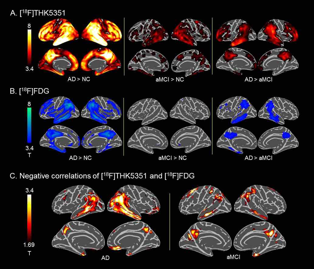 A. 알츠하이머치매, 경도인지장애, 정상대조군의 THK5351 비교 그림. B. 알츠하이머 치매, 경도인지장애, 정상대조군의 포도당 PET 의 비교 그림. C. 알츠하이머치매와 경도인지장애에서 THK5351 PET 과 포도당PET 가 유의미한 음적 상관관계를 보이는 영역