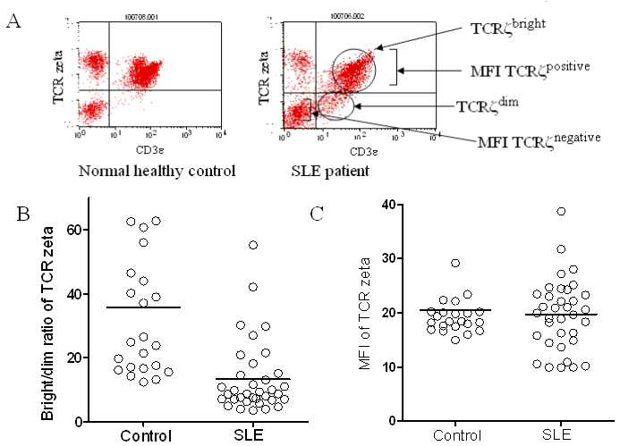 SLE환자와 대조군에서의 TCRζ의 상대적인 발현. A는 SLE와 대조군의 대표도이고, B는 TCR zeta의 bright/dim ratio를 대조군과 SLE에서 비교한 그림으로 SLE에서 상대적으로 TCR zeta의 발현이 적다는 것을 알 수 있다. C는 MFI index를 대조군과 SLE에서 비교한 그림인데 차이가 별로 없다는 것을 알 수 있다