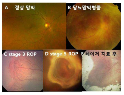 허혈증식성망막병증의 망막 소견 A. 정상 망막 사진. B. 당뇨망막병증 망막 사진. 망막의 허혈에 기인한 심한 섬유혈관막의 증 식을 보임. C. 미숙아망막병증 stage 3의 임상 양상. 망막 혈관이 발달해 있는 부위와 그렇지 않은 무혈관 부위 경계에서 비정상적 섬유혈관 증식을 보임. D. 견인망막박리로 인해 전체 망막이 박리된 stage 5 ROP 망막 사진. E. 레이저 치료후 섬유혈관증식이 퇴행한 모습