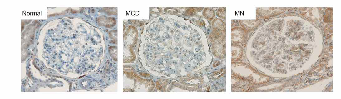 NOX4 immunohistochemistry analysis. 막성사구체신염에서 사구체내 NOX4의 발현이 유의하게 증가함을 확인함