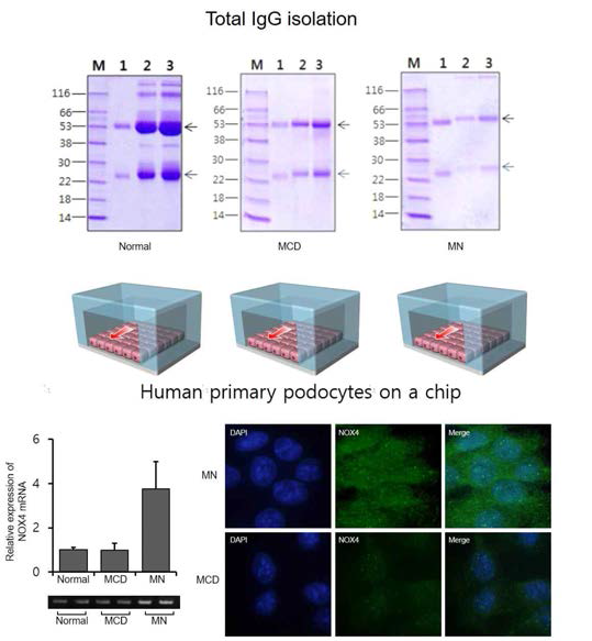 막성사구체신염 및 미세변화성사구체신염 환자의 진단 당시 serum에서 total IgG purification 후 chip에 infusion 함. 족세포의 NOX4의 mRNA expression은 막성사구체신염 환자의 IgG infusion 시에 유의하게 증가하였으며, confocal analysis에서도 동일한 pattern을 보임