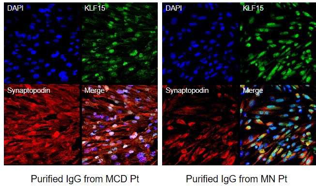 MCD 환자(좌) 및 MN 환자 (우)의 purified IgG infusion 후 chip의 족세포 synaptopodin 및 KLF15 발현. MN 환자의 purified IgG infusion 후 족세포의 synaptopodin 발현의 감소를 확인함