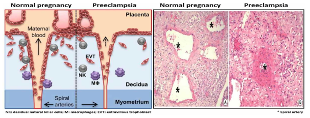 임신중독증의 발병 원인인 나선동맥으로의 비정상적인 영양막세포 침습