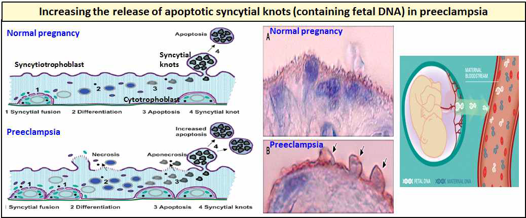 임신중독증 환자의 혈액내 태아DNA 증가 기작