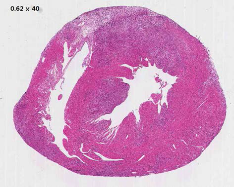 심근염 유발 렛드의 심장 조직소견. H&E염색상 분홍빛의 정삼 심장 사이로 진한 보라색의 염증세포 침윤 소견을 확인할 수 있으며, 그 사이 심장 부종으로 인한 밝은 부분도 함께 확인할 수 있음