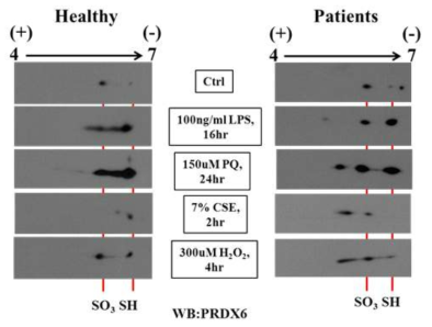 정상인과 환자군에 PBMC에 처리된 antioxidant에 따른 PRDX6발현 변화. 정상인과 환자에 PBMC를 분리하여, 다양한 종류에 agonist (LPS, PQ, CSE, H2O2)를 처리한후 2-PAGE and western blotting을 수행하여 PRDX6의 spot이동패턴 비교