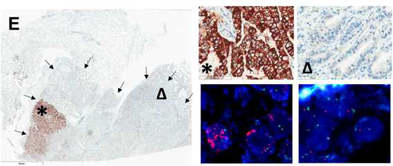 A MET-mutated adenocarcinoma (inCase No. 6) exhibited heterogeneous MET expression by IHC (arrows) (E). In the area with a MET IHC score of 3 (asterisk), MET gene amplification was detected by FISH(below). By contrast, in the area with MET IHC score of 0 (triangle), a disomic MET gene status was detected by FISH (below)