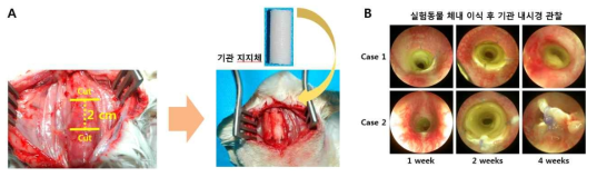 기관 협착 동물 모델 제작. A. 실험동물 토끼의 기관 절개 및 기관 지지체 체내 도입. B. 후두 내시경을 이용한 기관 지지체 내경 관찰 결과 육아종 형성으로 인한 기관 협착 확인